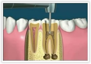 endo2